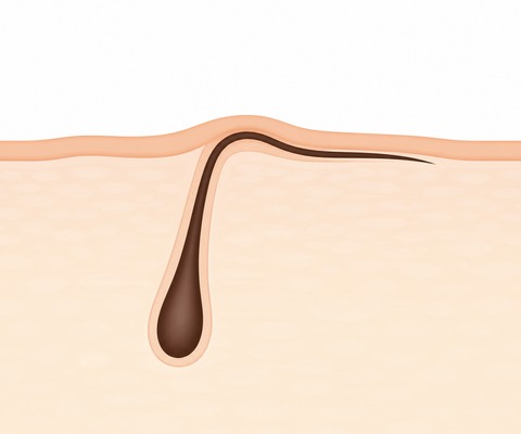 埋没毛はくるくるしてる？埋もれ毛の種類