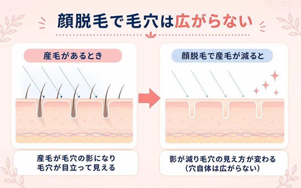顔脱毛で毛穴は広がらない