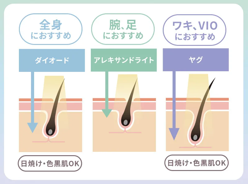 脱毛機に搭載されるレーザー3種類