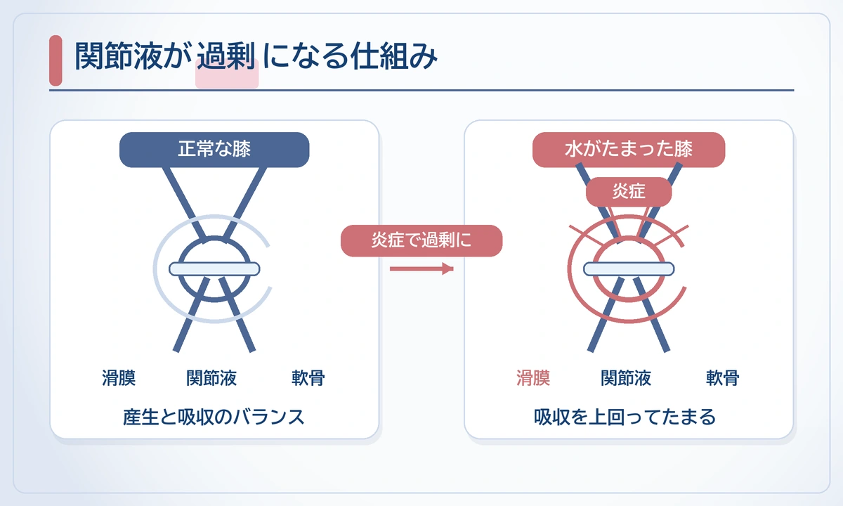 膝に水がたまる関節水腫とは