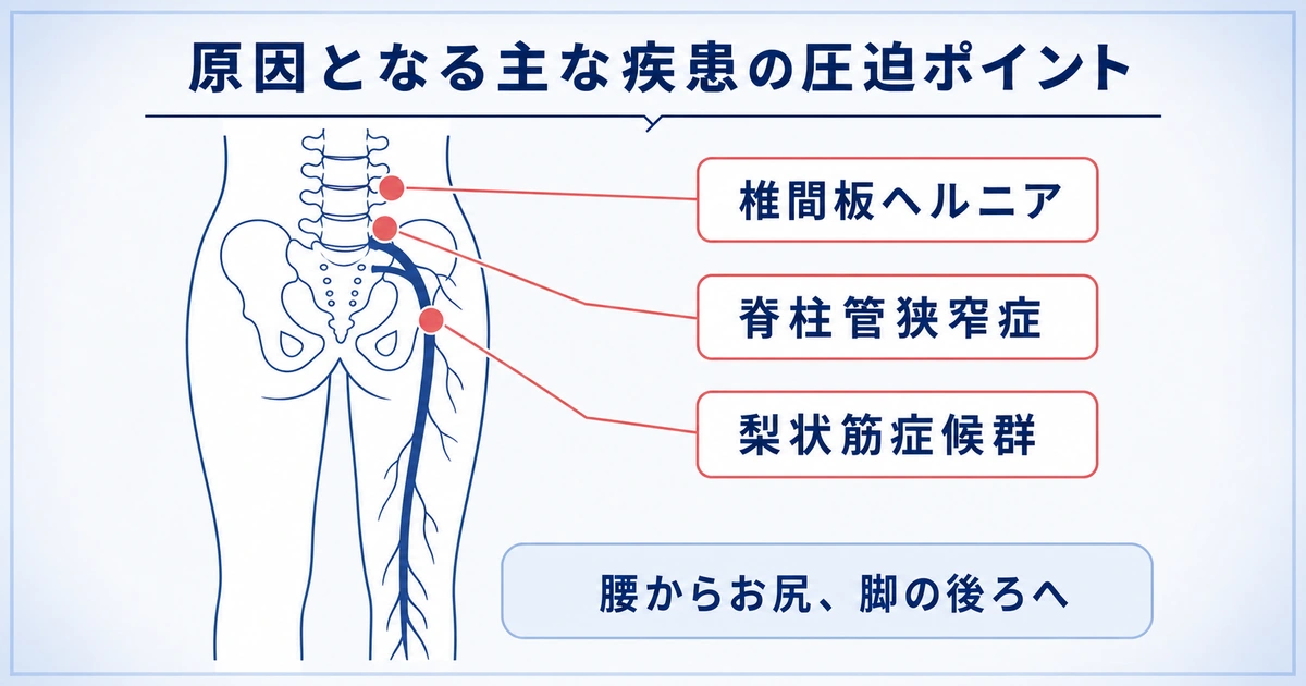 坐骨神経痛の原因と悪化を招く仕組み