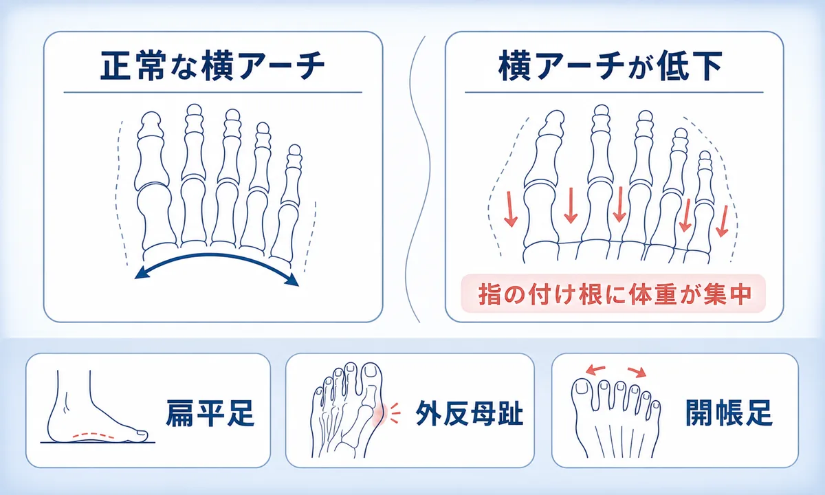 モートン病の原因となりやすい人の特徴