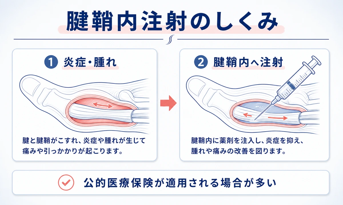 腱鞘炎の病院での治療はステロイド注射から手術まで