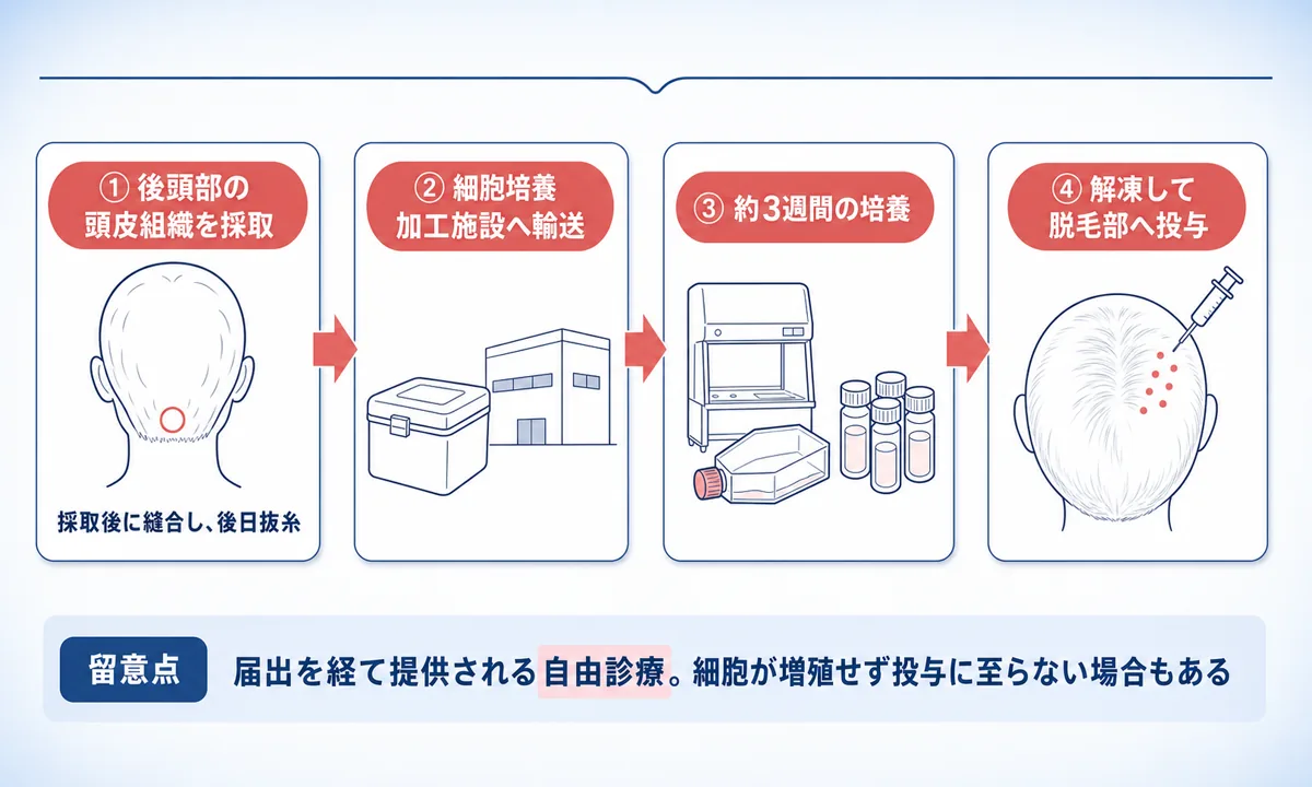 後頭部の頭皮組織を採取してから培養加工施設で培養し、脱毛部へ投与するまでの工程を4段階で示した流れ図