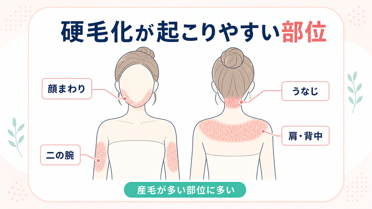 硬毛化しやすい人・なりやすい部位