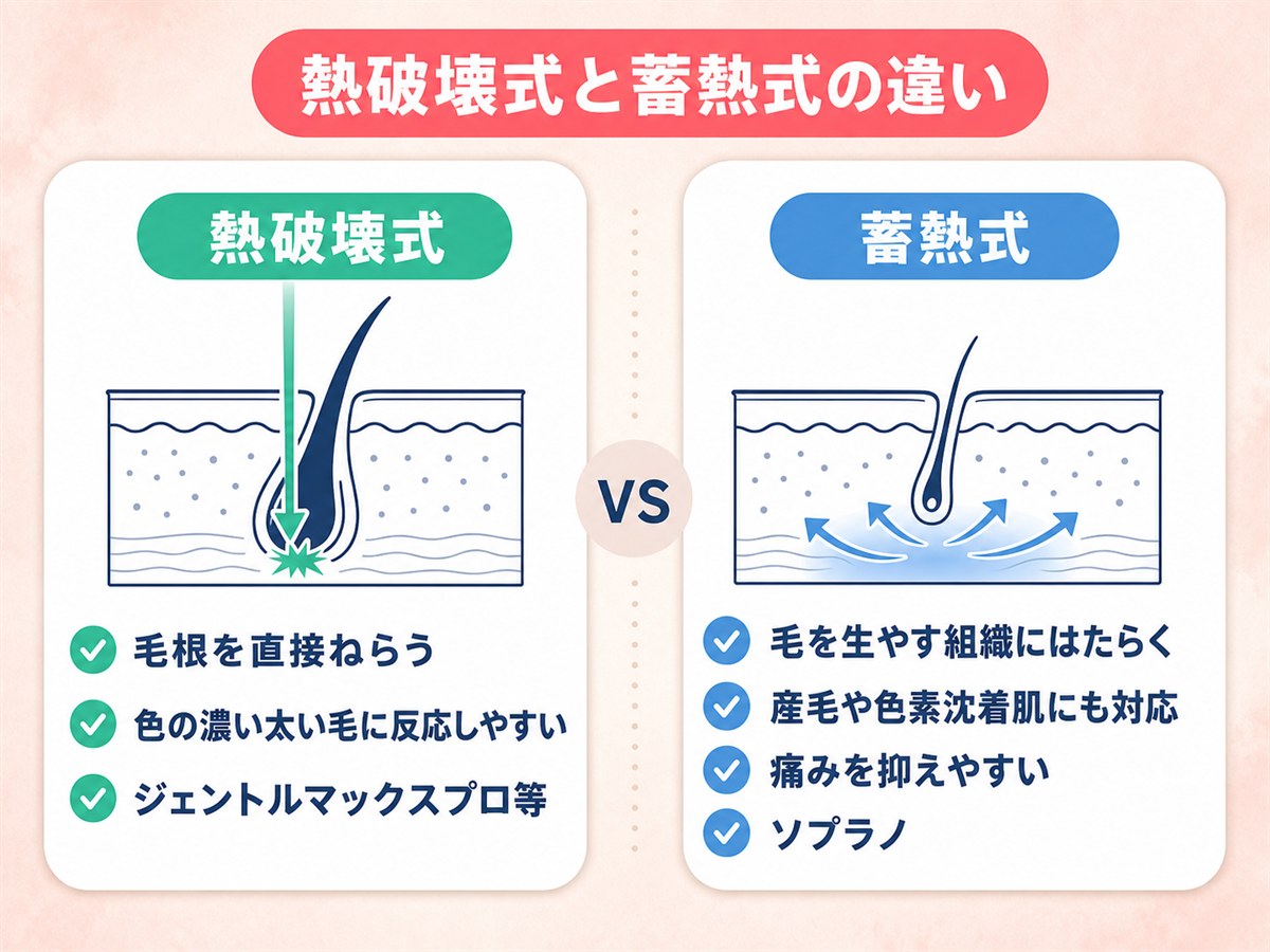レジーナクリニックの熱破壊式と蓄熱式の照射方式の違いを示す図解