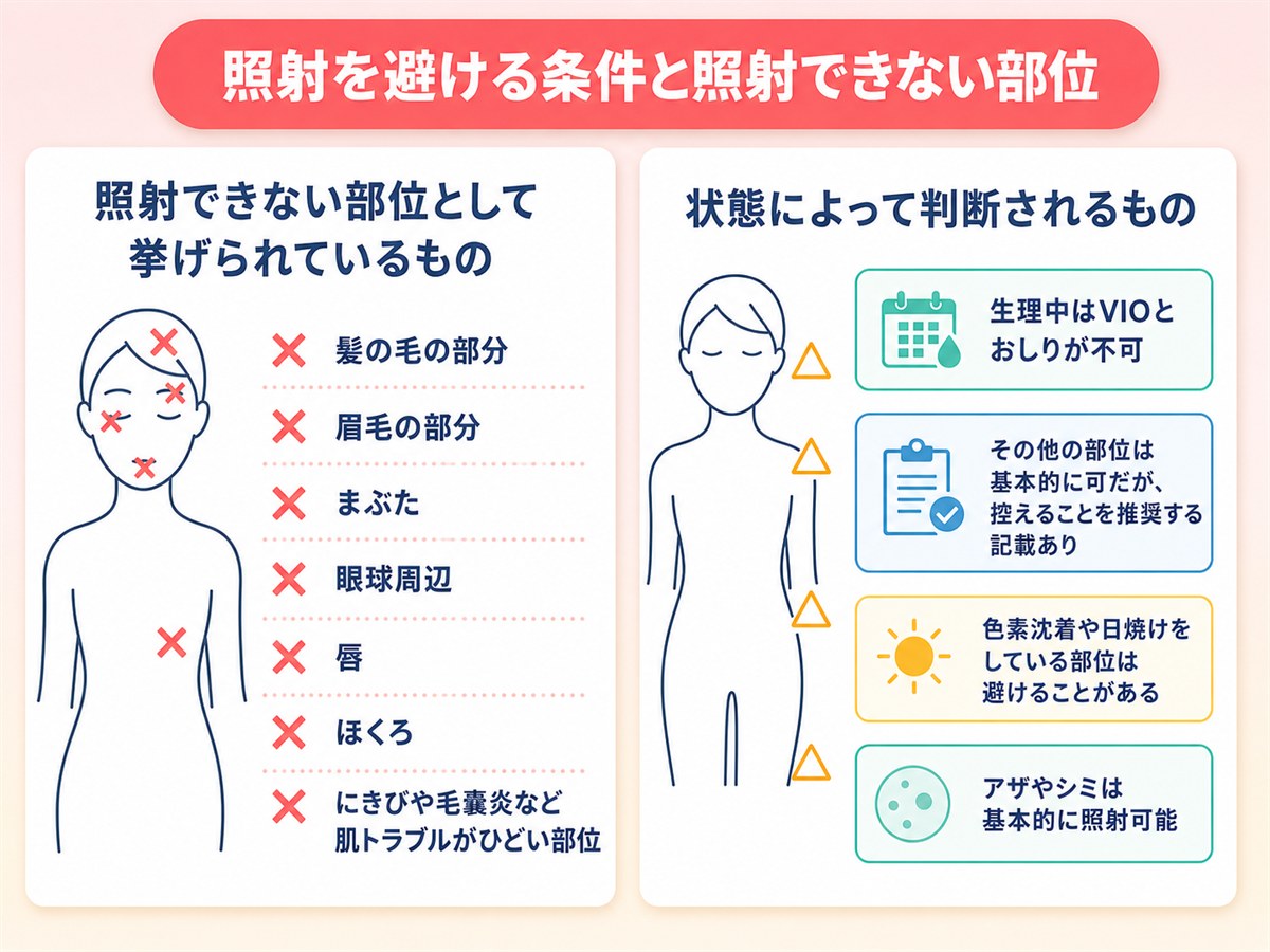 TCB脱毛で照射を避ける条件と照射できない部位